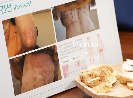 생기한의원으로 알아보는 건선 기본 개념과 피부 변화